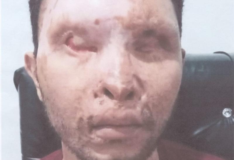 Chandra korban penyiraman air keras